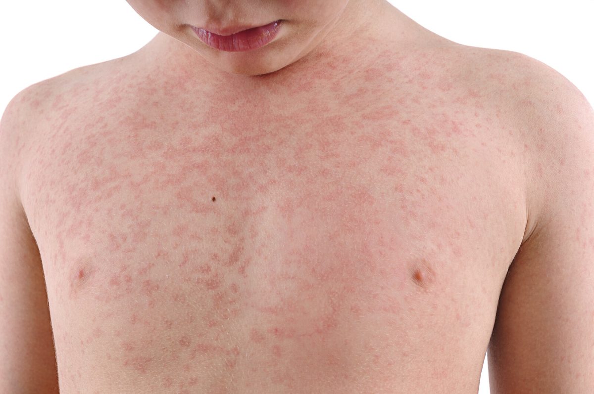 cuerpo-nino-urticaria-1200x797.jpg