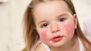 dermatitis-atopica.jpeg